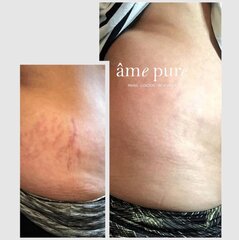 Набор для микроигольчатой ​​терапии для тела âme pure® Body Basic | Stretch Marks Kit цена и информация | Антицеллюлитные кремы, средства для упругости кожи | kaup24.ee